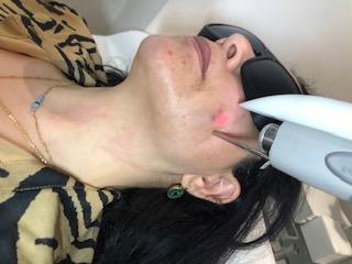 Traitement laser & Hydrafacial pour peaux à tendance acnéique à Paris 8 par NewLase