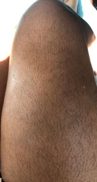 Epilation laser : une solution pour se débarrasser des poils indésirables