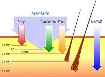 Pourquoi choisir l'épilation laser plutôt que l'épilation à la lumière pulsée?