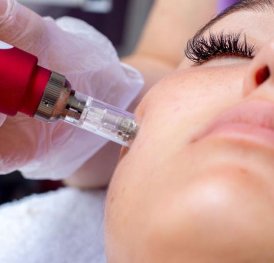 Microneedling visage