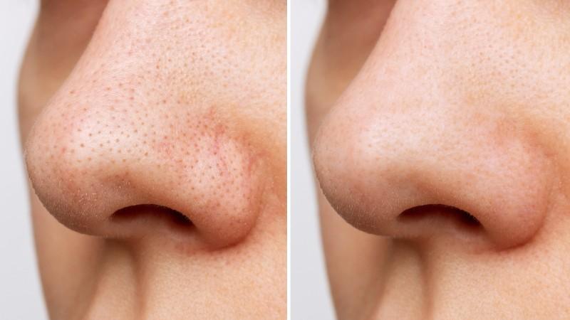 Vous avez les pores ouverts? Avez -vous essayé le peeling SRT?