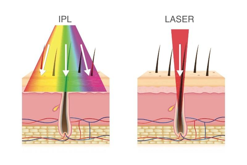 Peut-on faire une épilation laser et partir en  vacances au soleil ?