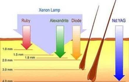 Pourquoi choisir l'épilation laser plutôt que l'épilation à la lumière pulsée?