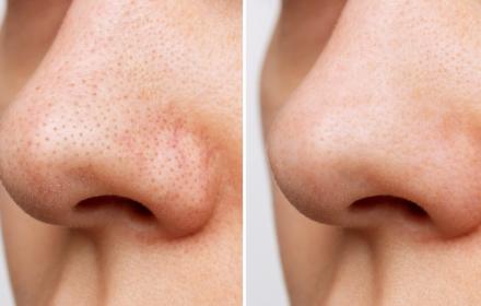 Vous avez les pores ouverts? Avez -vous essayé le peeling SRT?