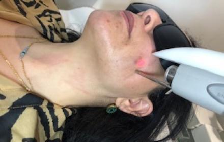 Traitement laser & Hydrafacial pour peaux à tendance acnéique à Paris 8 par NewLase